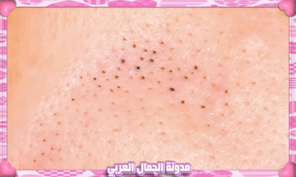 الرؤوس السوداء (Blackheads)