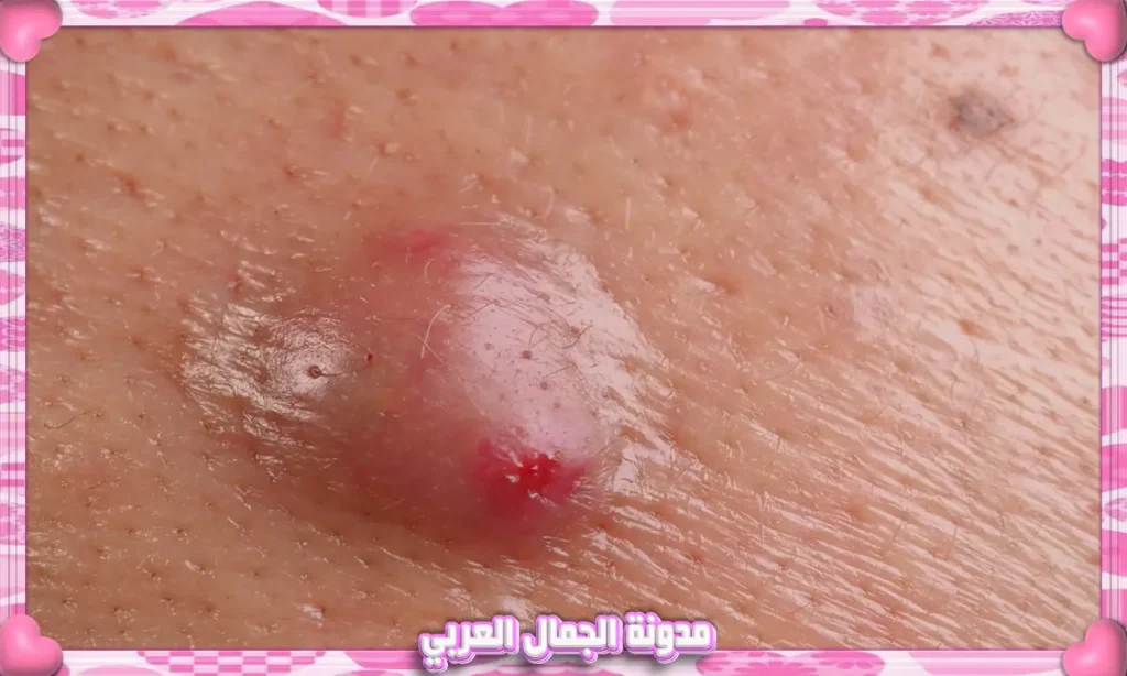 حب الشباب الكيسي (Cysts)