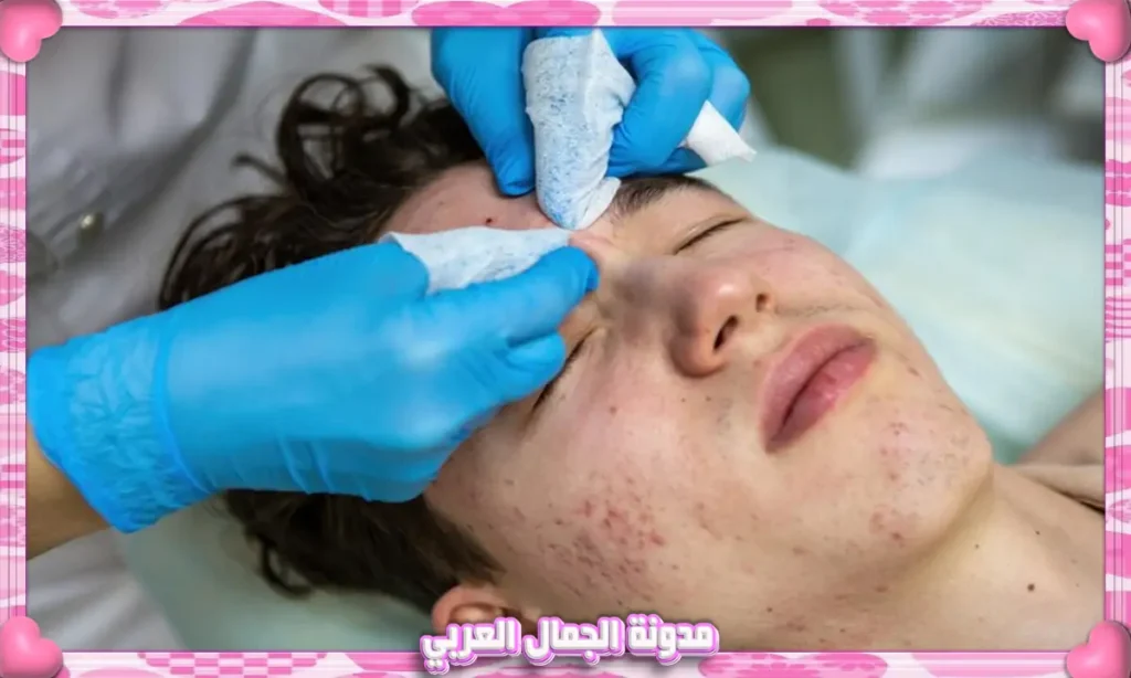 العلاجات الطبية والتقشير للحبوب الجلدية