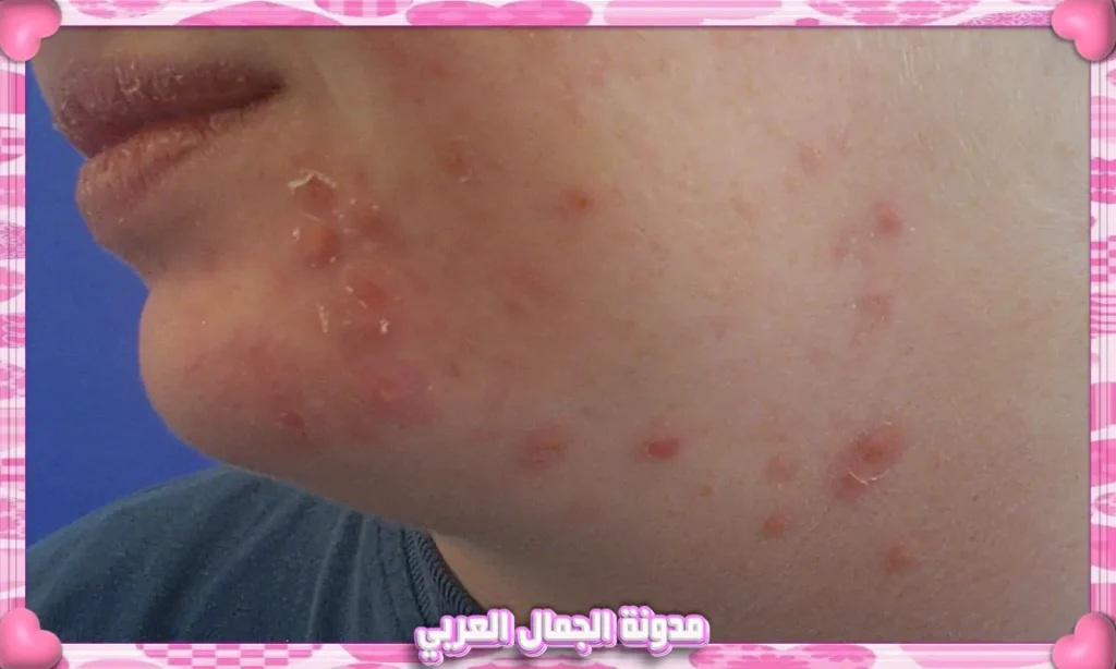 الحطاطات (Papules)