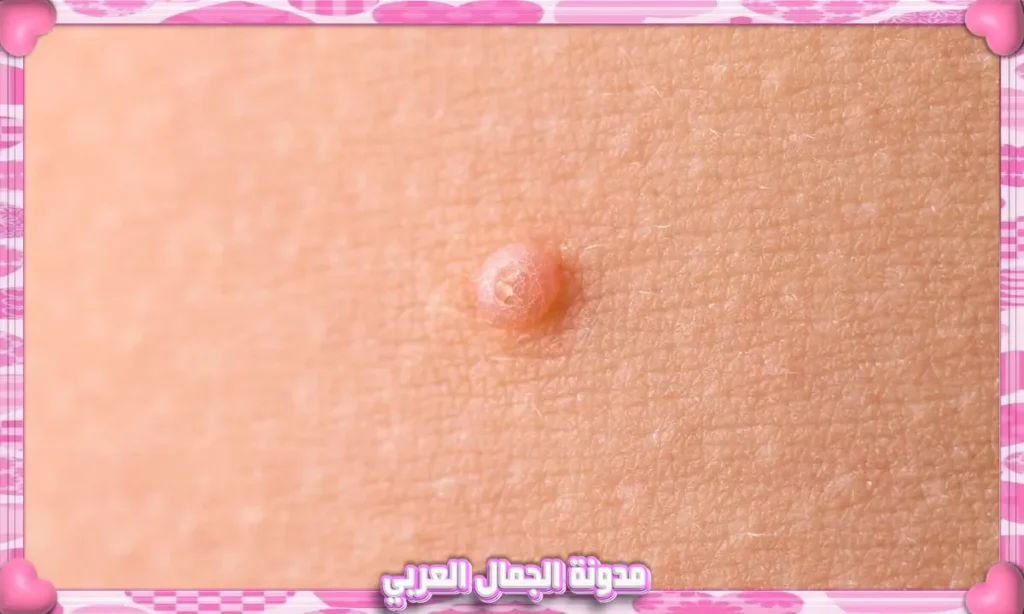 عقيدات الجلد (Skin Nodules)