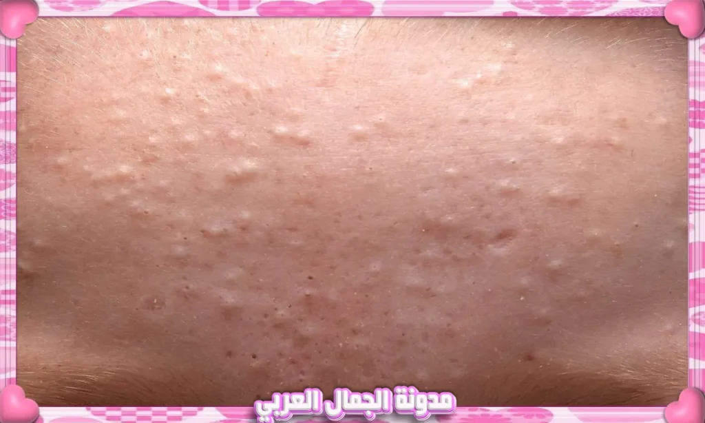 الرؤوس البيضاء (Whiteheads)